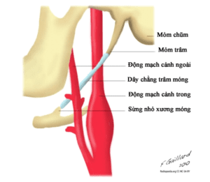 Hình 1. Ảnh minh họa mỏm trâm xương thái dương.