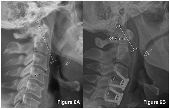 Hình 6. Chụp X-quang cột sống cổ tư thế nghiêng.