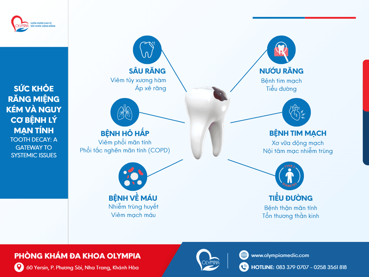 sức khỏe răng miệng kém có thể trở thành nguyên nhân tiềm ẩn dẫn đến nhiều bệnh lý nghiêm trọng