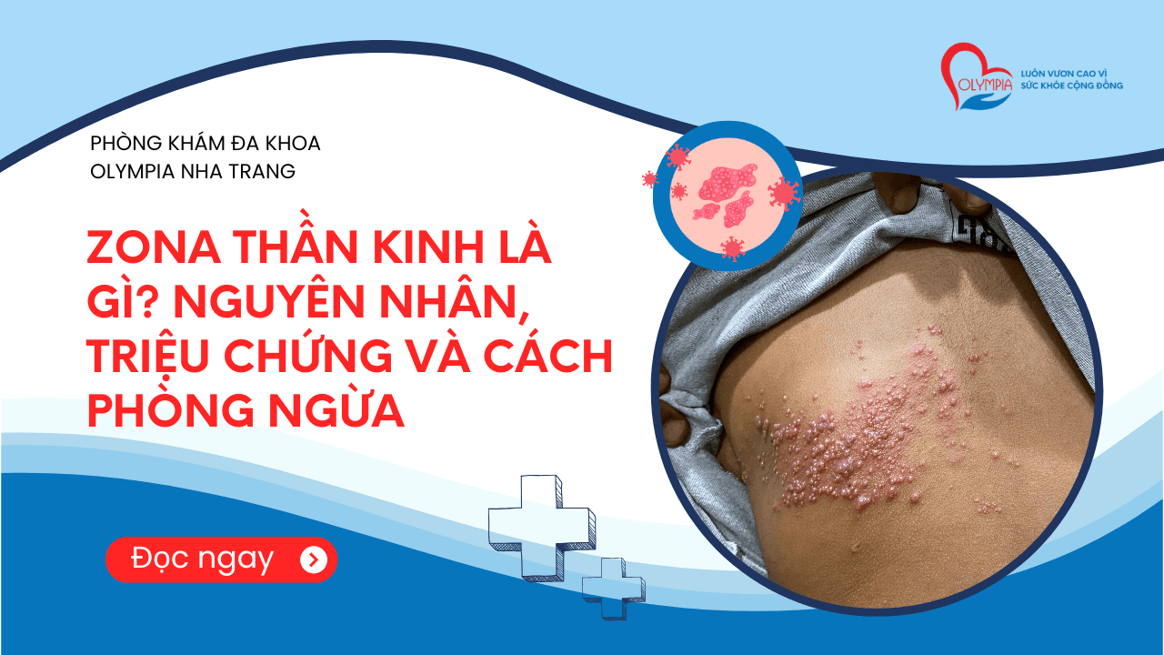 Zona Thần Kinh Là Gì- Nguyên Nhân, Triệu Chứng Và Cách Phòng Ngừa - phòng khám đa khoa olympia