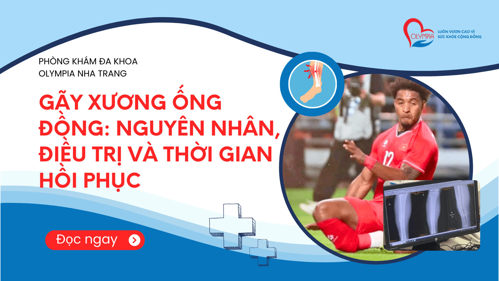 Gãy Xương Ống Đồng - Nguyên Nhân, Điều Trị và Thời Gian Hồi Phục- phòng khám đa khoa olympia