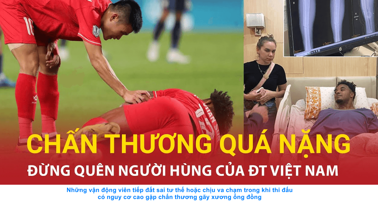 Hình ảnh chụp phim xương ống đồng bị gãy của Xuân Son