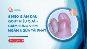 8 Mẹo Giảm Đau Gout Hiệu Quả – Giảm Sưng Viêm, Ngăn Ngừa Tái Phát phòng khám đa khoa olympia