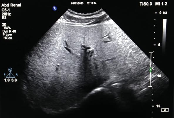 1 Siêu âm đàn hồi gan FibroScan - tại Phòng khám đa khoa olympia