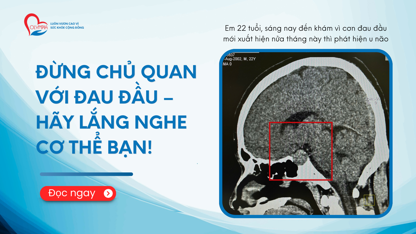 Đừng Chủ Quan Với Đau Đầu – Hãy Lắng Nghe Cơ Thể Bạn! - u tuyến yên - phòng khám đa khoa olympia - ths bs võ hà quang vinh