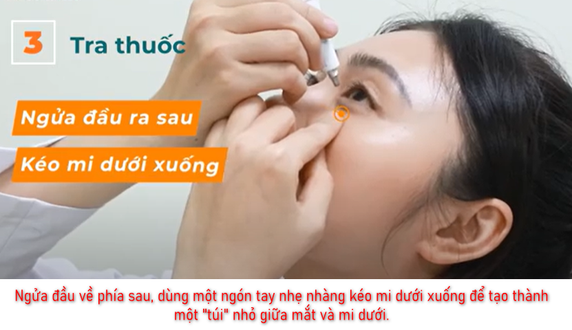 Ngửa đầu về phía sau, dùng một ngón tay nhẹ nhàng kéo mi dưới xuống để tạo thành một "túi" nhỏ giữa mắt và mi dưới.