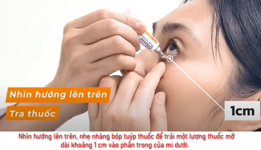 Nhìn hướng lên trên, nhẹ nhàng bóp tuýp thuốc để trải một lượng thuốc mỡ dài khoảng 1 cm vào phần trong của mi dưới.