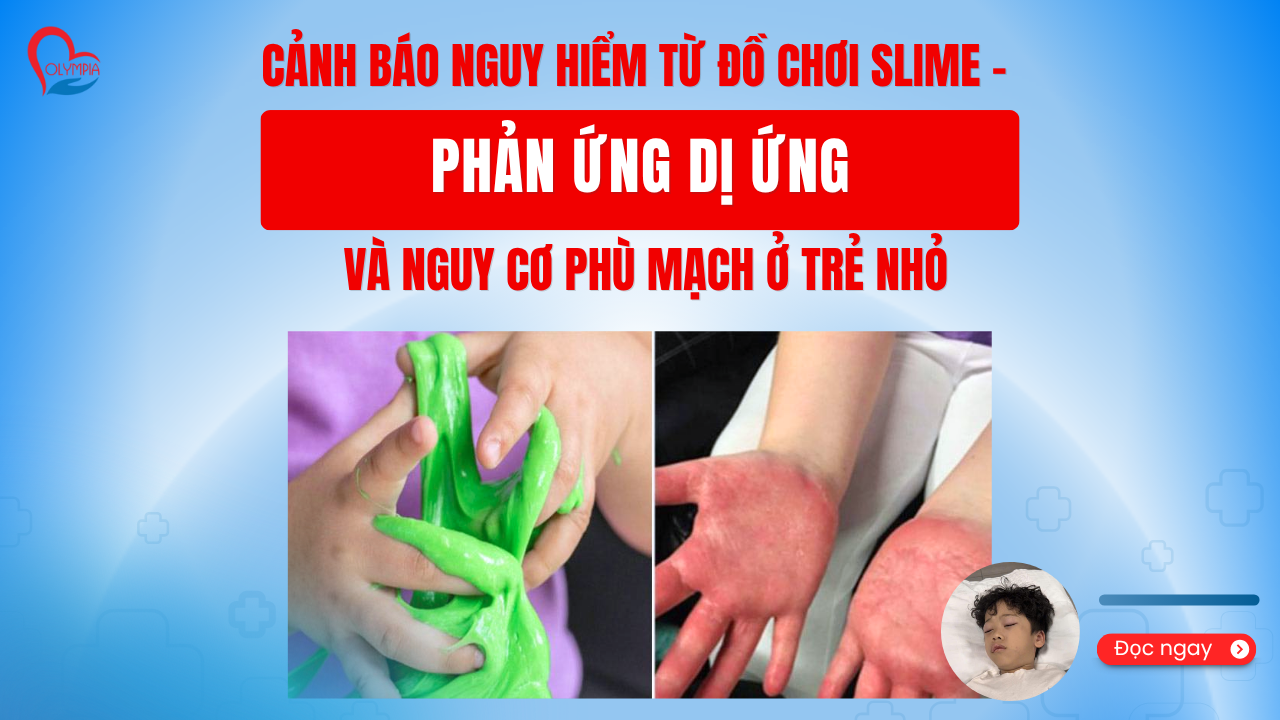 Cảnh báo nguy hiểm từ đồ chơi Slime - Phản ứng dị ứng và nguy cơ phù mạch ở trẻ nhỏ -phòng khám đa khoa olympia