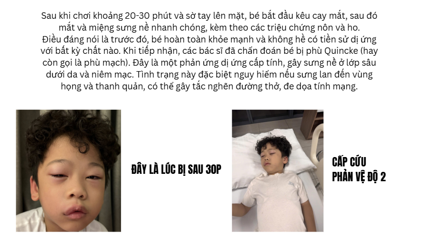 Bé trai 5 tuổi bị phù mạch sau 30 phút chơi Slime