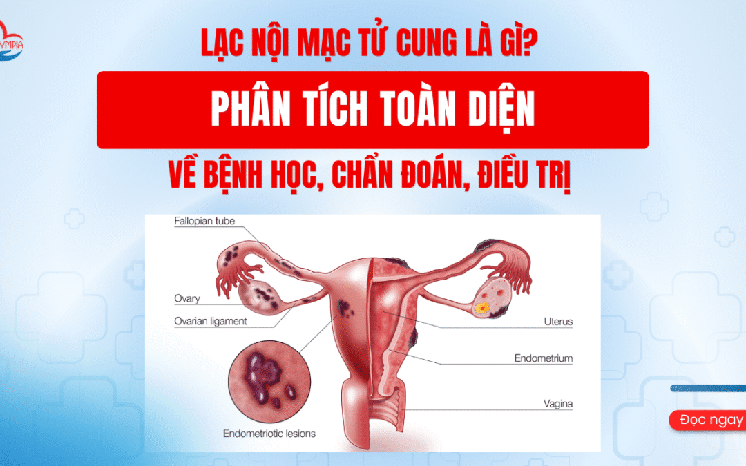 Lạc nội mạc tử cung là gì? Phân tích Toàn diện về Bệnh học, Chẩn đoán, Điều trị