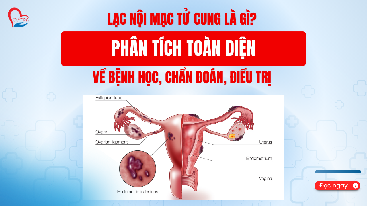 Lạc nội mạc tử cung là gì Phân tích Toàn diện về Bệnh học, Chẩn đoán, Điều trị - phòng khám đa khoa olympia