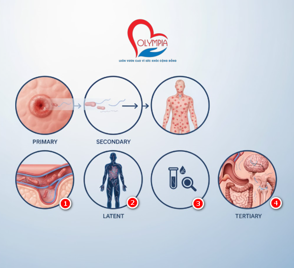 Giang mai không tấn công rầm rộ như phim hành động. Nó len lỏi, từng bước một, qua bốn giai đoạn – mỗi giai đoạn là một “mặt nạ” khác nhau mà xoắn khuẩn Treponema pallidum sử dụng để đánh lừa cơ thể và cả người mắc bệnh.