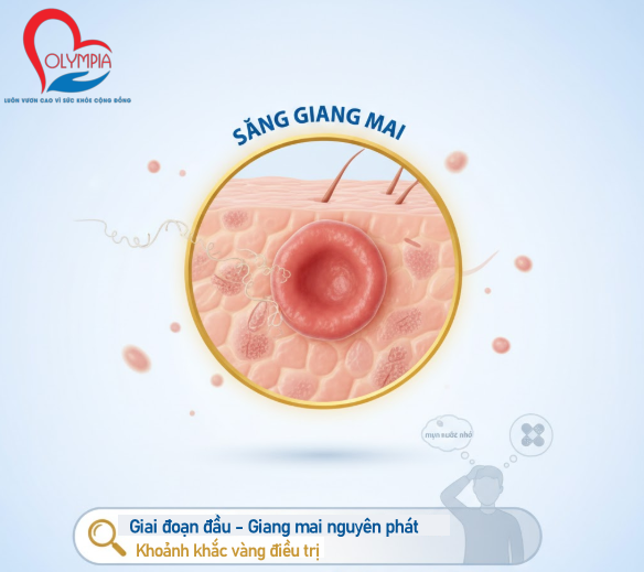 Giai đoạn đầu – gọi là giang mai nguyên phát – thường là “khoảnh khắc vàng” để phát hiện và chữa trị. Nhưng trớ trêu thay, đây cũng là giai đoạn dễ bị bỏ qua nhất.