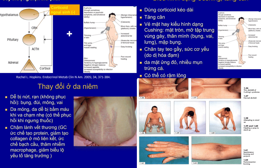 Chia sẻ bài giảng Biến chứng Glucocorticoid