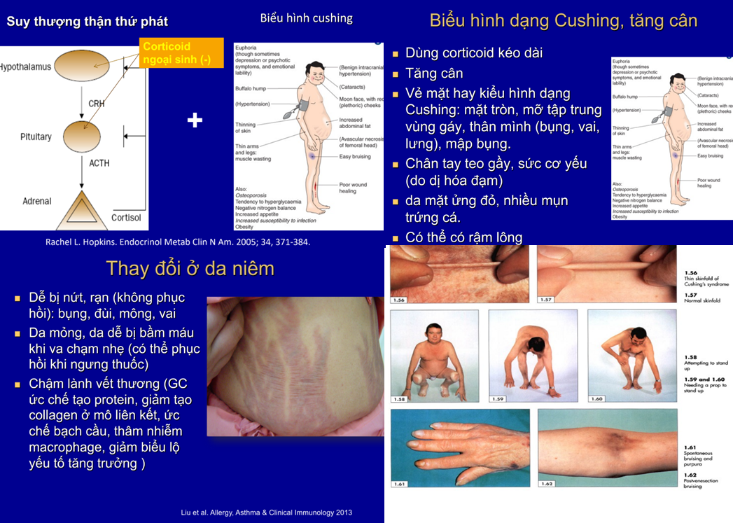Dựa trên các slide hình ảnh lâm sàng (Slide 8, 11, 13, 15), bệnh nhân sử dụng corticoid liều cao kéo dài sẽ có sự thay đổi ngoại hình đặc trưng, gọi là biểu hình Cushing (Cushingoid appearance) Dựa trên các slide hình ảnh lâm sàng (Slide 8, 11, 13, 15), bệnh nhân sử dụng corticoid liều cao kéo dài sẽ có sự thay đổi ngoại hình đặc trưng, gọi là biểu hình Cushing (Cushingoid appearance)