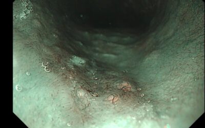 Dấu Hiệu Hình Chữ Alpha (α) Trên NBI – “Mật Mã” Của Ung Thư Thực Quản Xâm Lấn