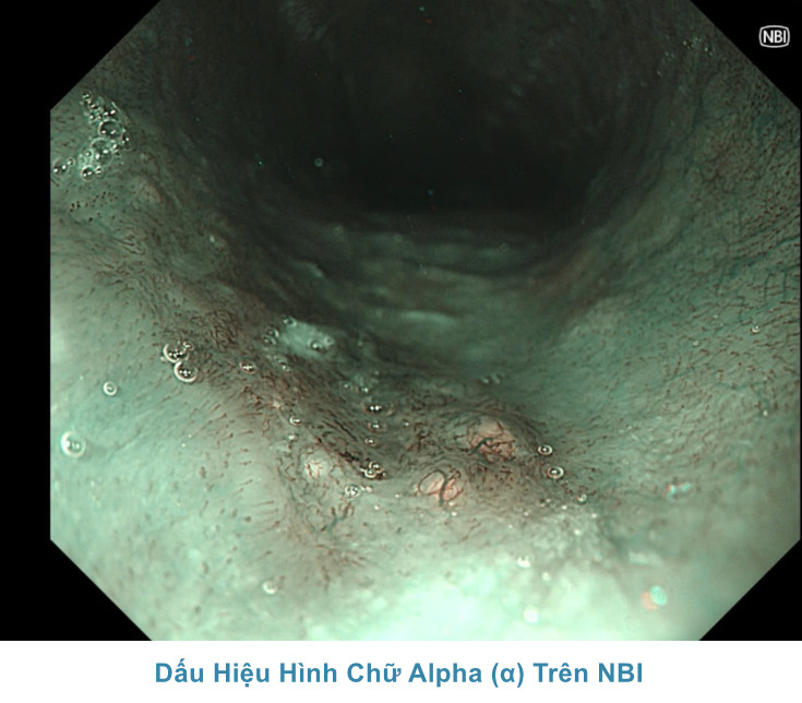 Dấu Hiệu Hình Chữ Alpha (α) Trên NBI