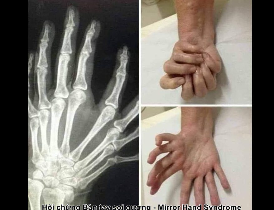 Hội Chứng Bàn Tay Soi Gương (Mirror Hand Syndrome) – Dị Tật Bẩm Sinh Hiếm Gặp