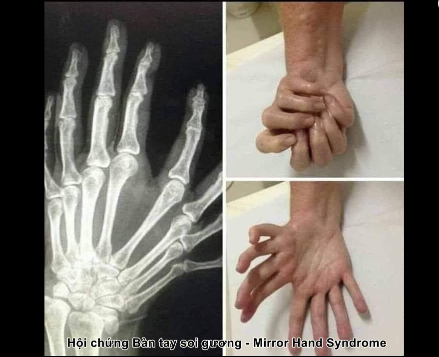 Hội chứng Bàn tay soi gương - Mirror Hand Syndrome - phong kham da khoa olympia