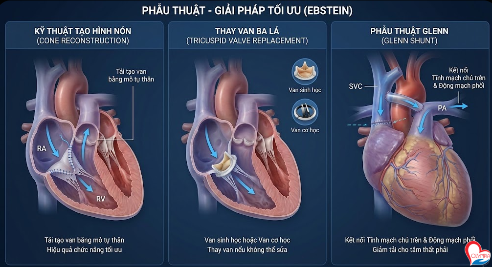 Điều trị và quản lý bệnh Ebstein