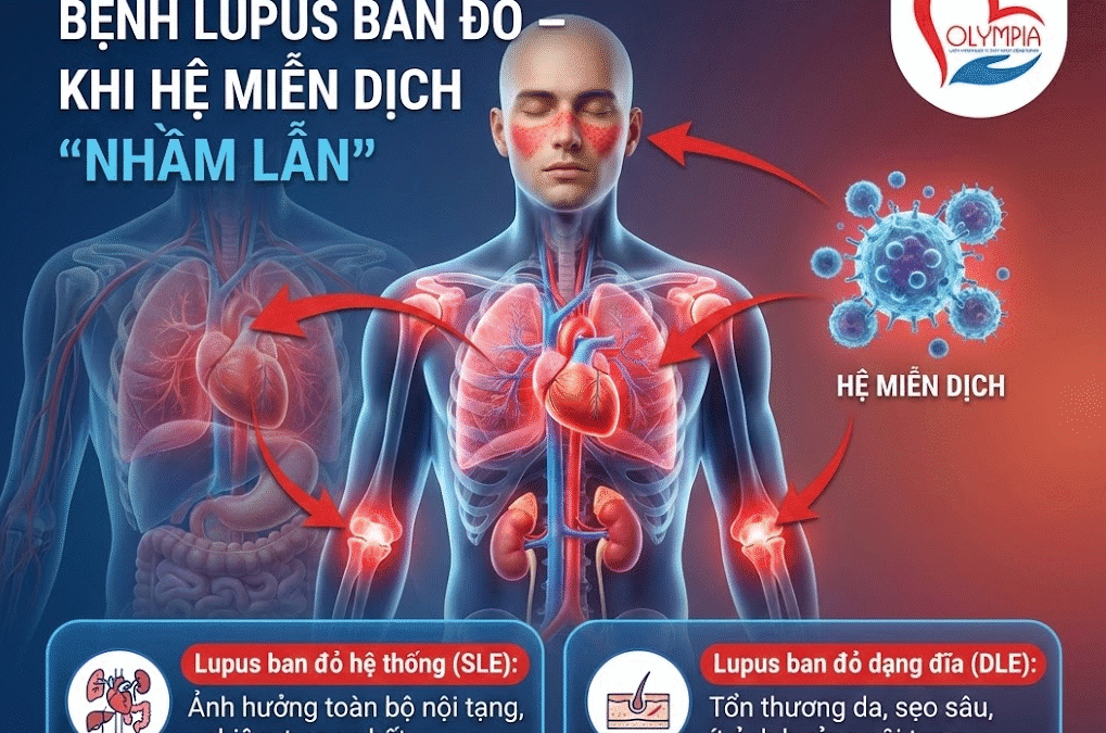 Bệnh lupus ban đỏ là bệnh gì? Dấu hiệu nhận biết và cập nhật điều trị mới nhất 2026