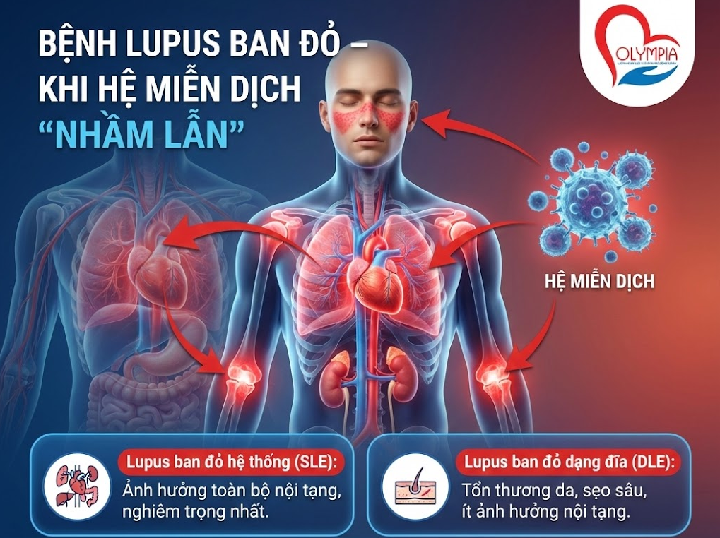 Bệnh lupus ban đỏ là bệnh gì?