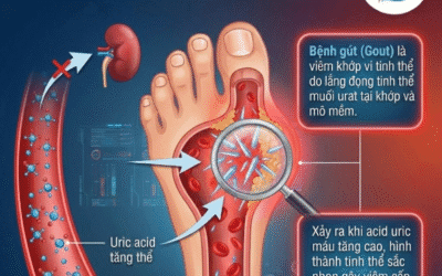 Bệnh gút là bệnh gì? Dấu hiệu, nguyên nhân và cập nhật y khoa 2026
