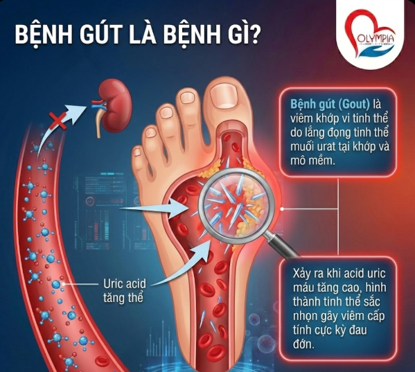 Bệnh gút là bệnh gì?