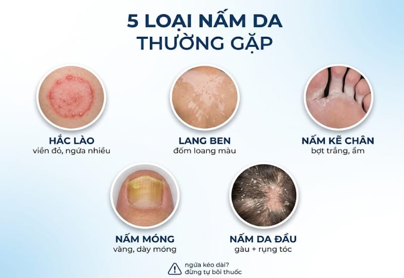 5 loại nấm da thường gặp
