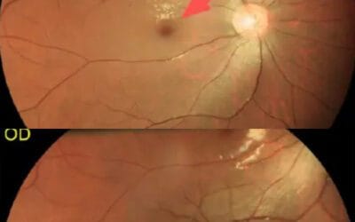 Chàng trai 24 tuổi đột ngột mù lòa, bác sĩ cảnh báo “thủ phạm” là loại đồ uống giới trẻ dùng thay nước lọc