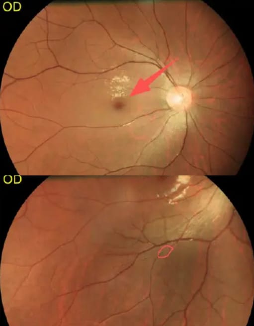 Anh bị tắc nghẽn động mạch võng mạc trung tâm (CRAO), hay còn được giới y khoa gọi là đột quỵ mắt