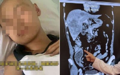 Chàng trai 18 tuổi mắc ung thư đại trực tràng giai đoạn 3, bác sĩ cảnh báo “khoảng trống 128 ngày” tử thần ở người trẻ