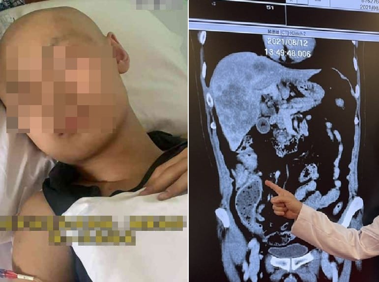 Chàng trai 18 tuổi mắc ung thư đại trực tràng giai đoạn 3, bác sĩ cảnh báo khoảng trống 128 ngày tử thần ở người trẻ