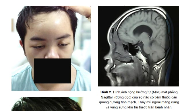 Thấy mủ ngoài màng cứng