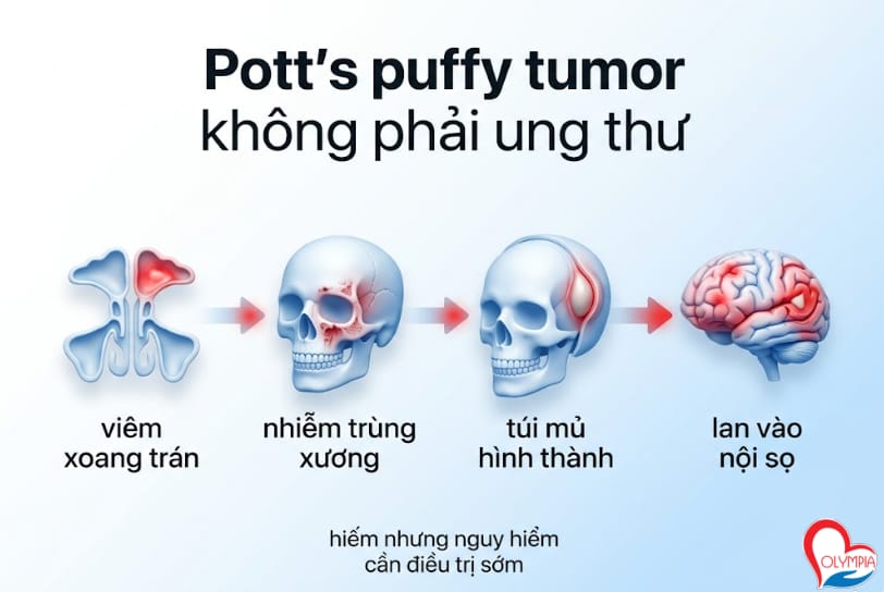 pott puffy tumor - không phải ung thư
