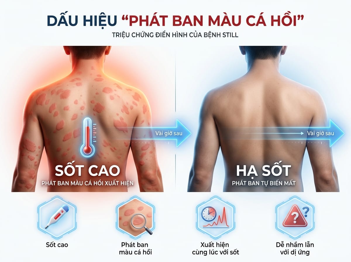 Ban đỏ màu cá hồi (Salmon-Pink Rash) - olympia nha trang