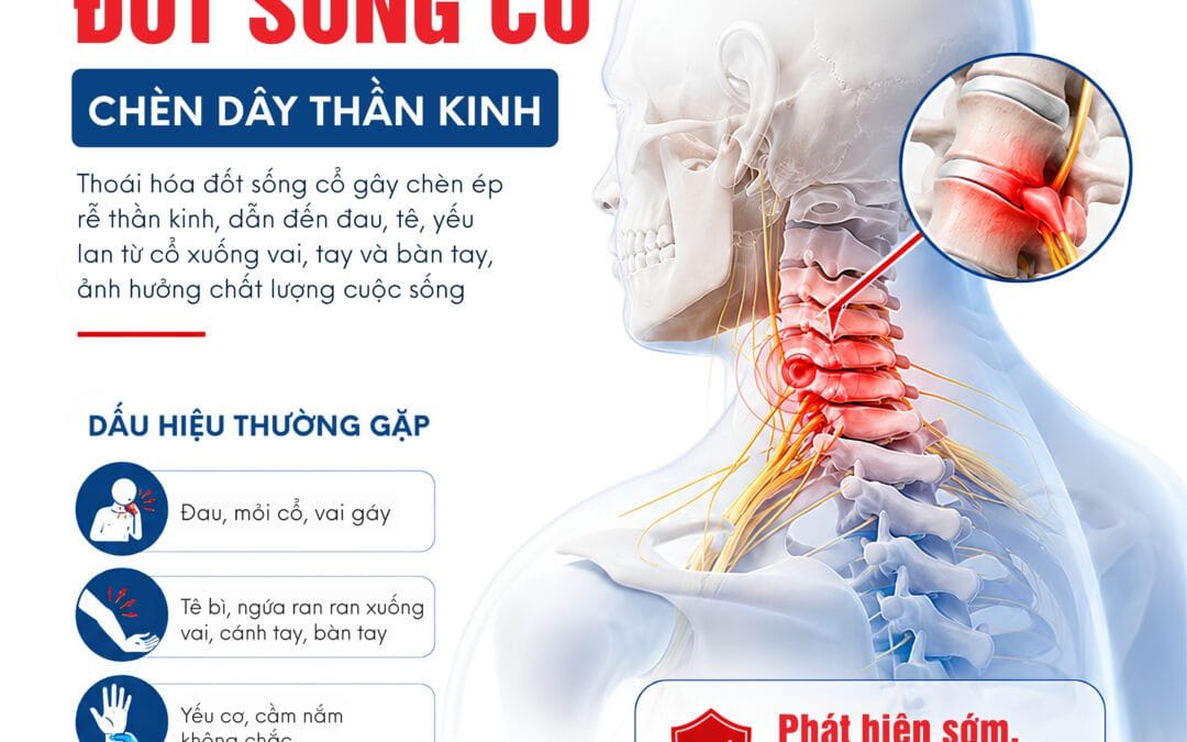 THOÁI HÓA ĐỐT SỐNG CỔ – ĐỪNG XEM NHẸ CƠN ĐAU MỎI VAI GÁY MỖI NGÀY!