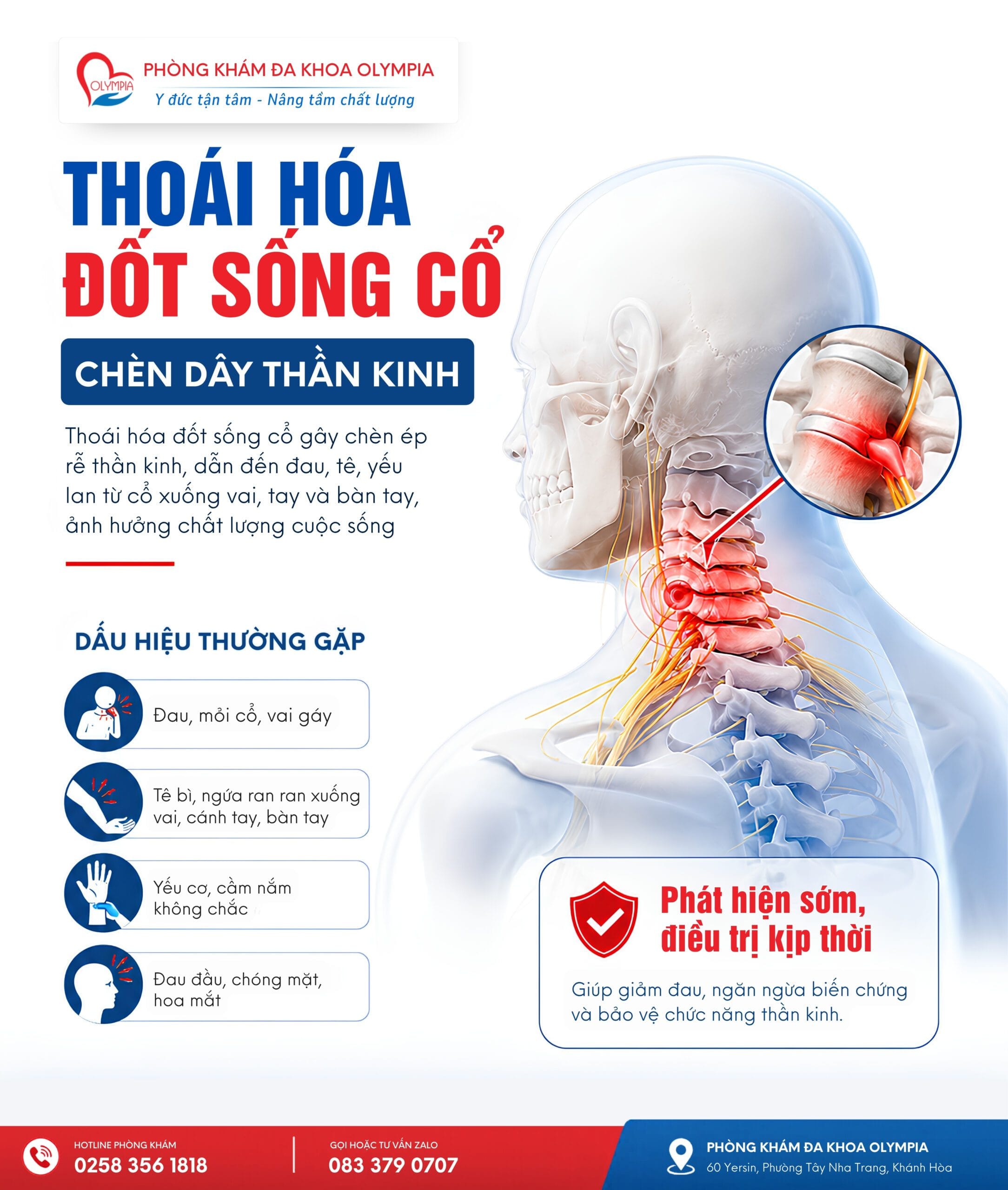 thoái hóa đốt sống cổ