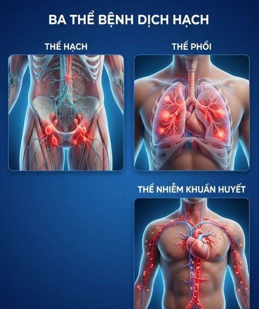 Ba thể bệnh dịch hạch: thể hạch, thể phổi và thể nhiễm khuẩn huyết